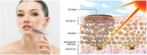 Nám da dễ xuất hiện khi chúng ta không chăm sóc da cẩn thận