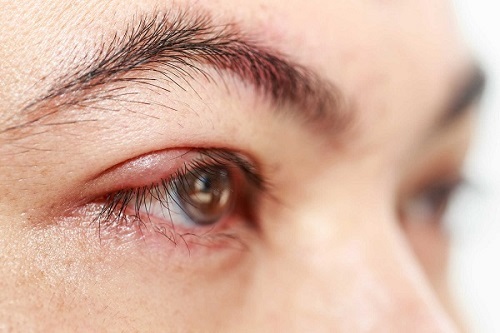 Việc nối mi giả khiến vùng mi mắt dễ tổn thương, có thể dẫn tới viêm mắt