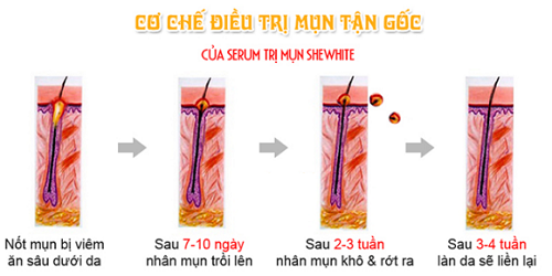 Cơ chế loại bỏ mụn của serum trị mụn Shewhite